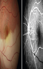 Conventional Retina Angiographies to be Digitised